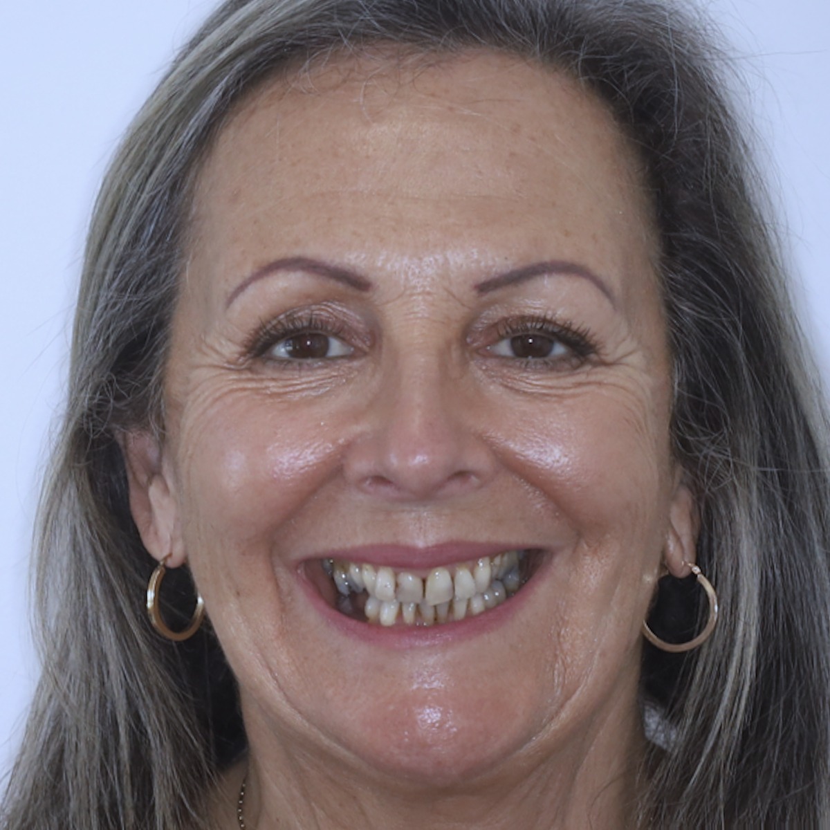 Before treatment